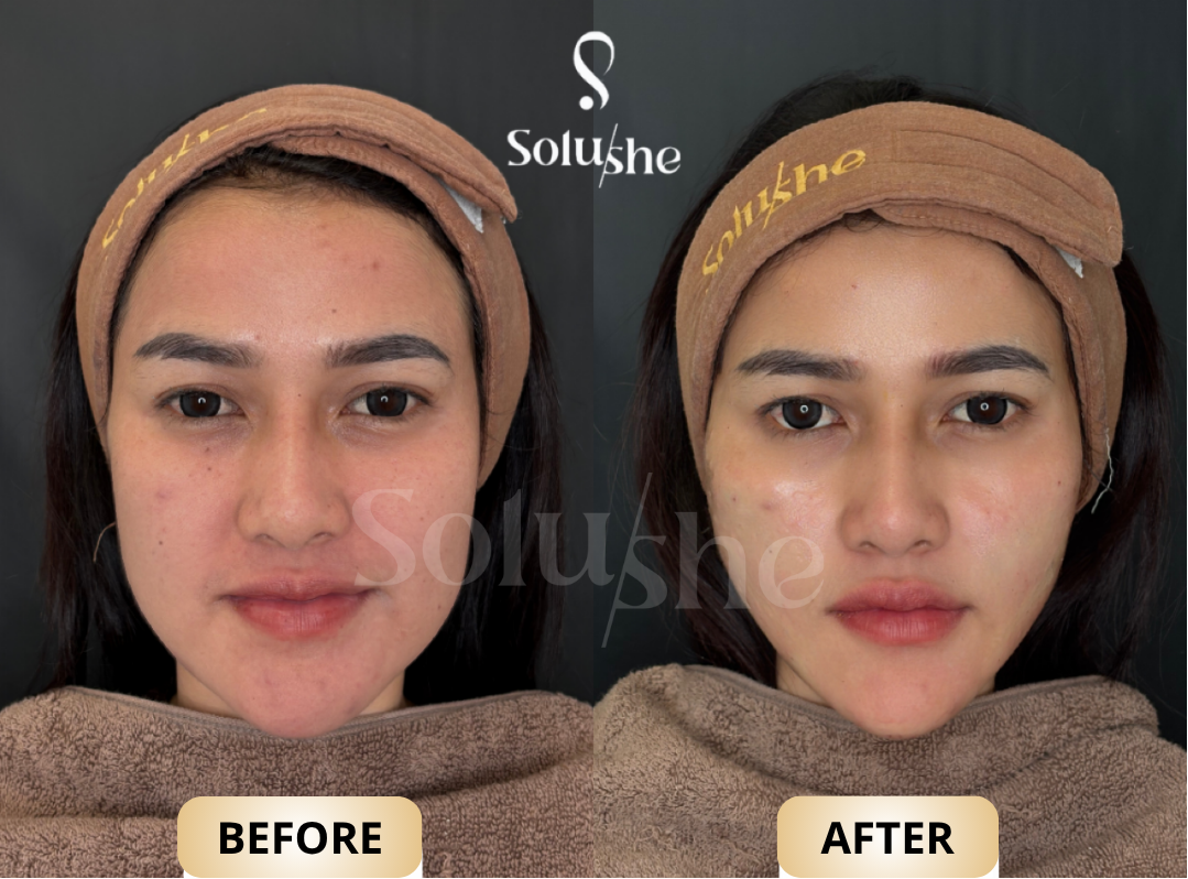 Hasil nyata before after Botox Jawline Solushe