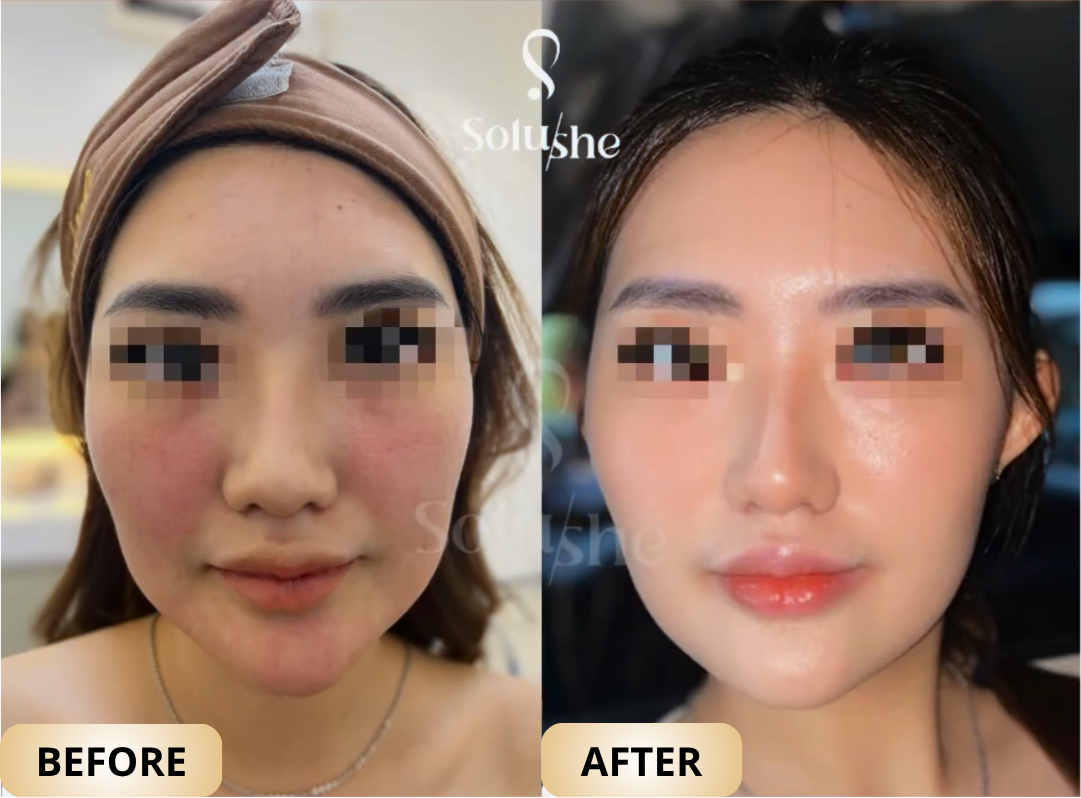 Hasil nyata before after Korean Pore Surgery Solushe