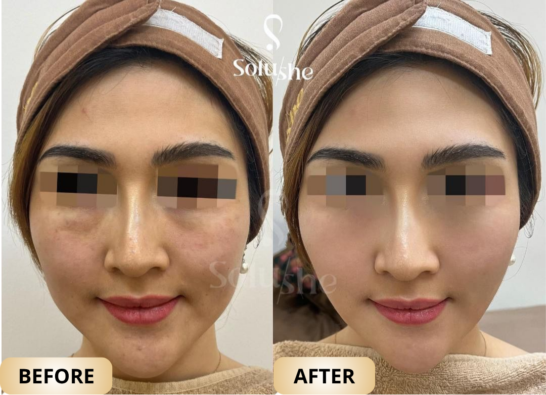 Hasil nyata before after Facelift Solushe