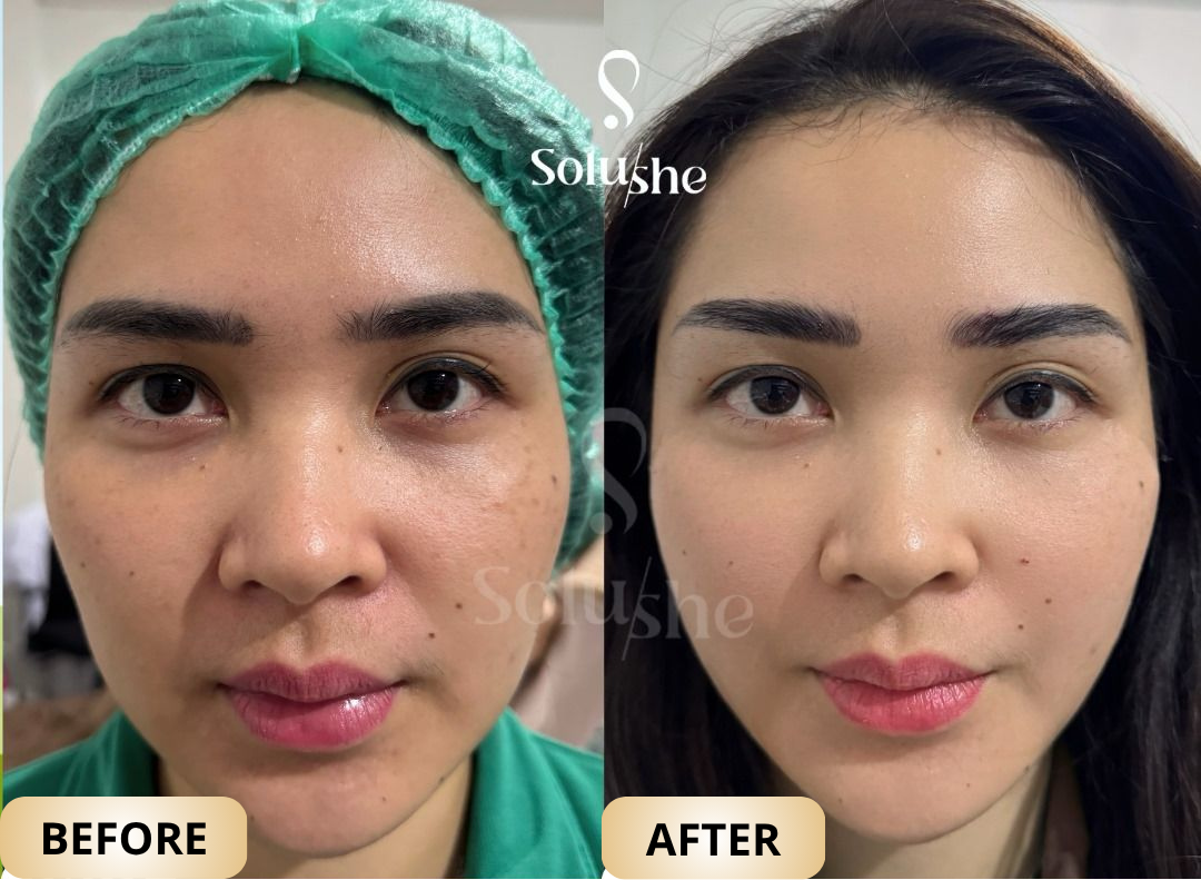 Hasil nyata before after Glowtox Solushe