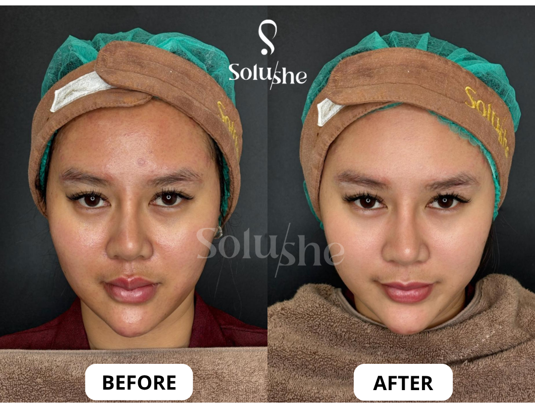 Hasil nyata before after Flawless Glow Solushe