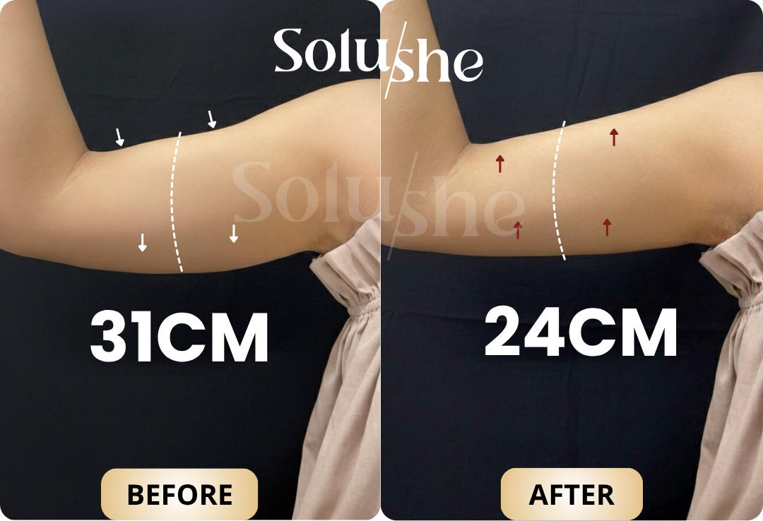 Hasil nyata before after Mesolifting (Body) Solushe