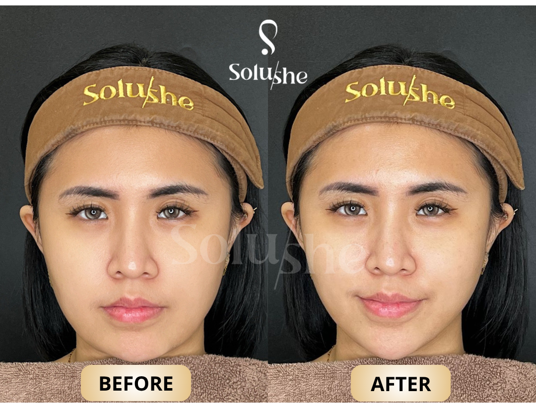 Hasil nyata before after Ultralift Solushe