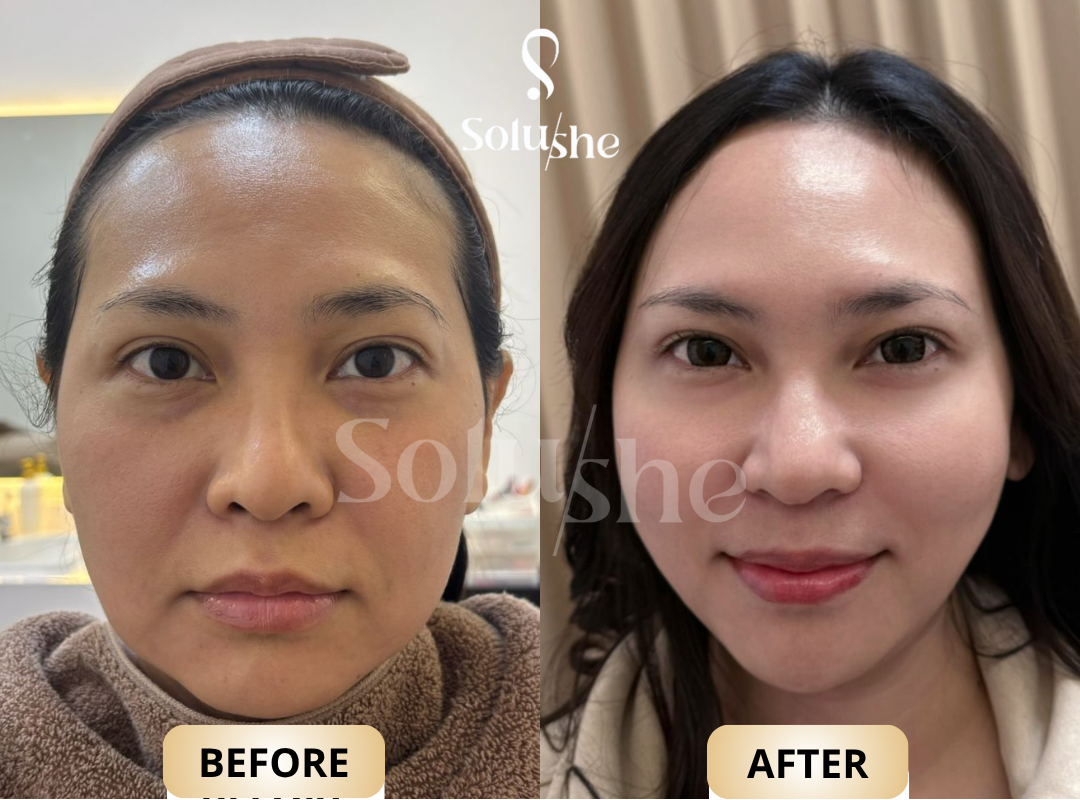 Hasil nyata before after Nucleofill Strong Solushe