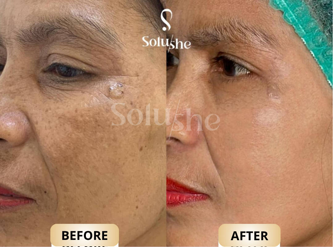 Hasil nyata before after Xela Rederm Solushe