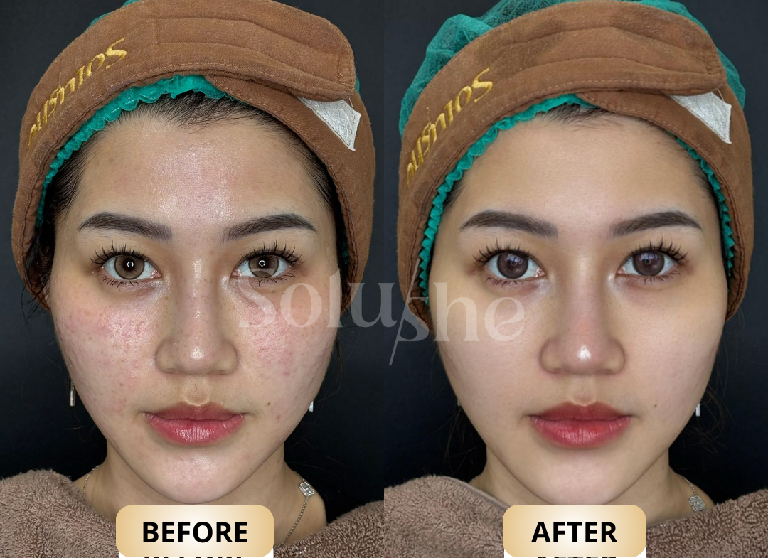 Hasil nyata before after Juvelook Solushe