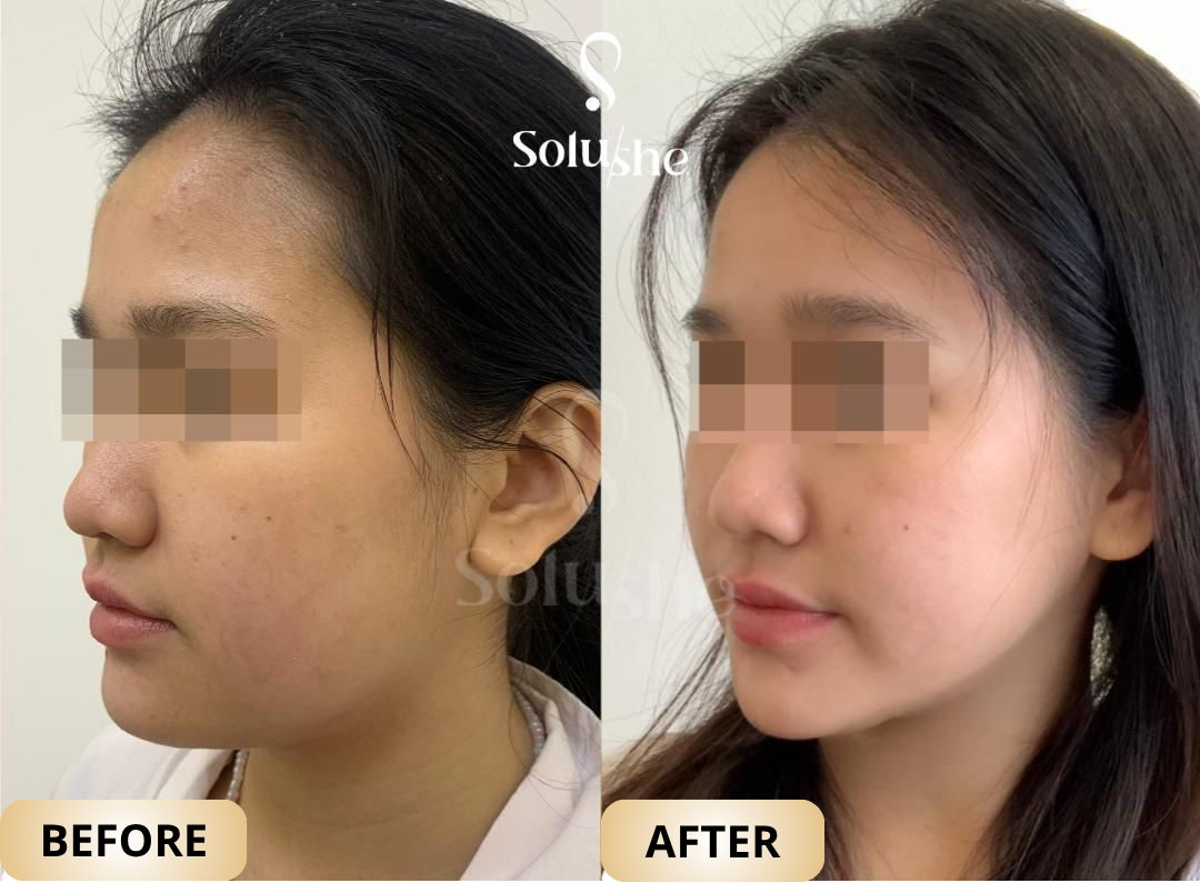 Hasil nyata before after Mesolifting (Face) Solushe