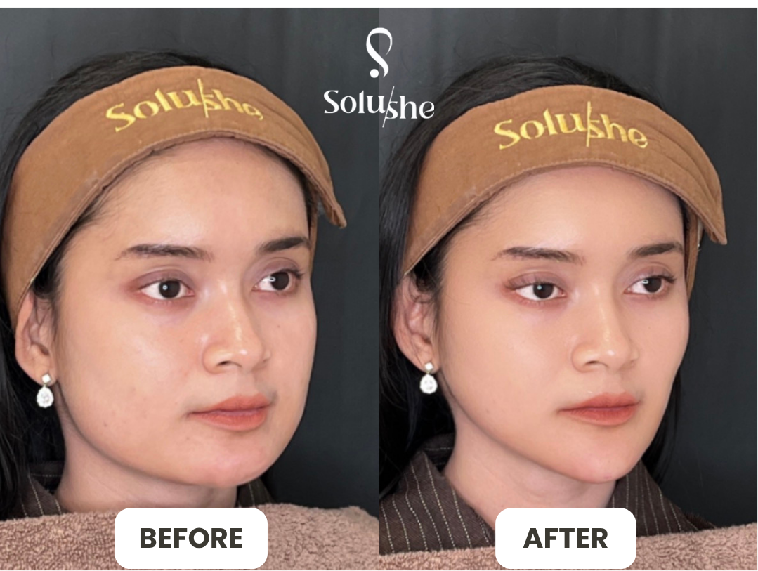 Hasil nyata before after Tirus Instant 1 Solushe
