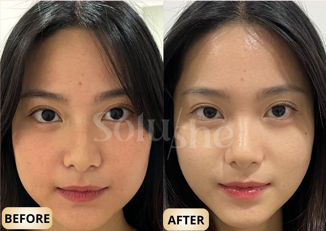 Hasil nyata before after Rejuran Solushe