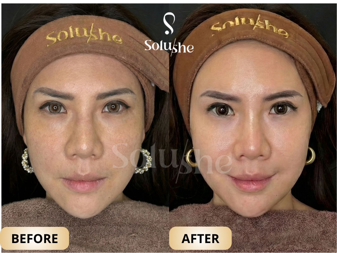 Hasil nyata before after Redensity1 Solushe