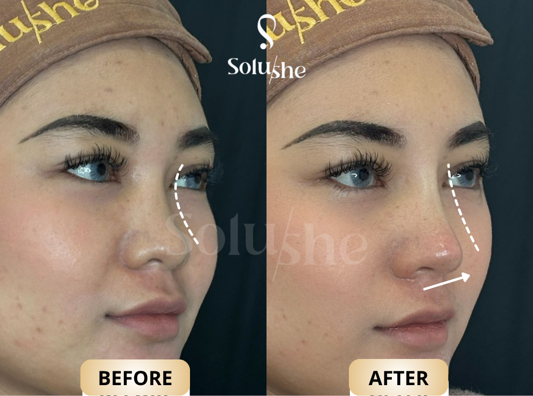 Hasil nyata before after Perfect Korean Nose Solushe