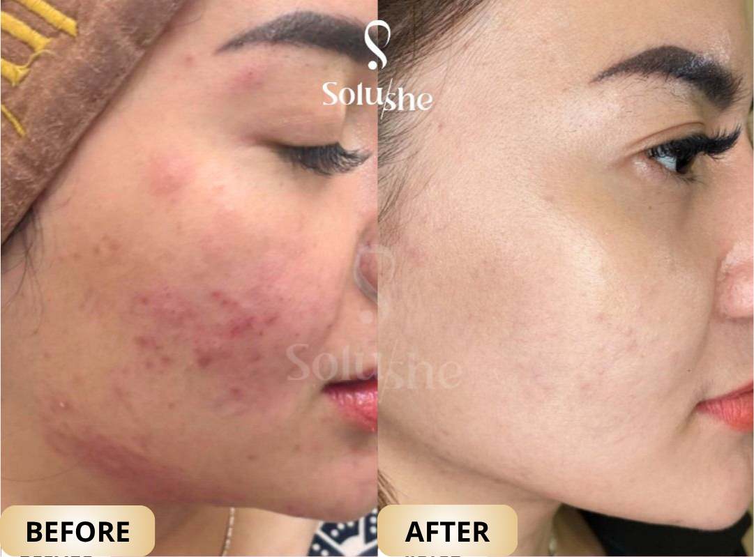 Hasil nyata before after Acne Mask Peel Solushe