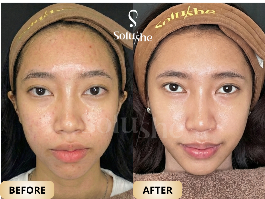 Hasil nyata before after EXOSOME ASCE Solushe