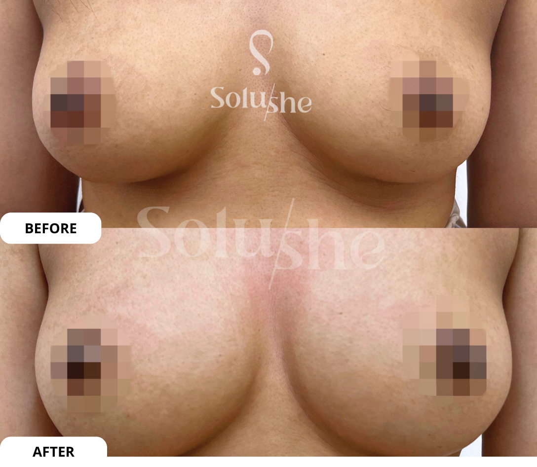 Hasil nyata before after Breast Magnifier Solushe