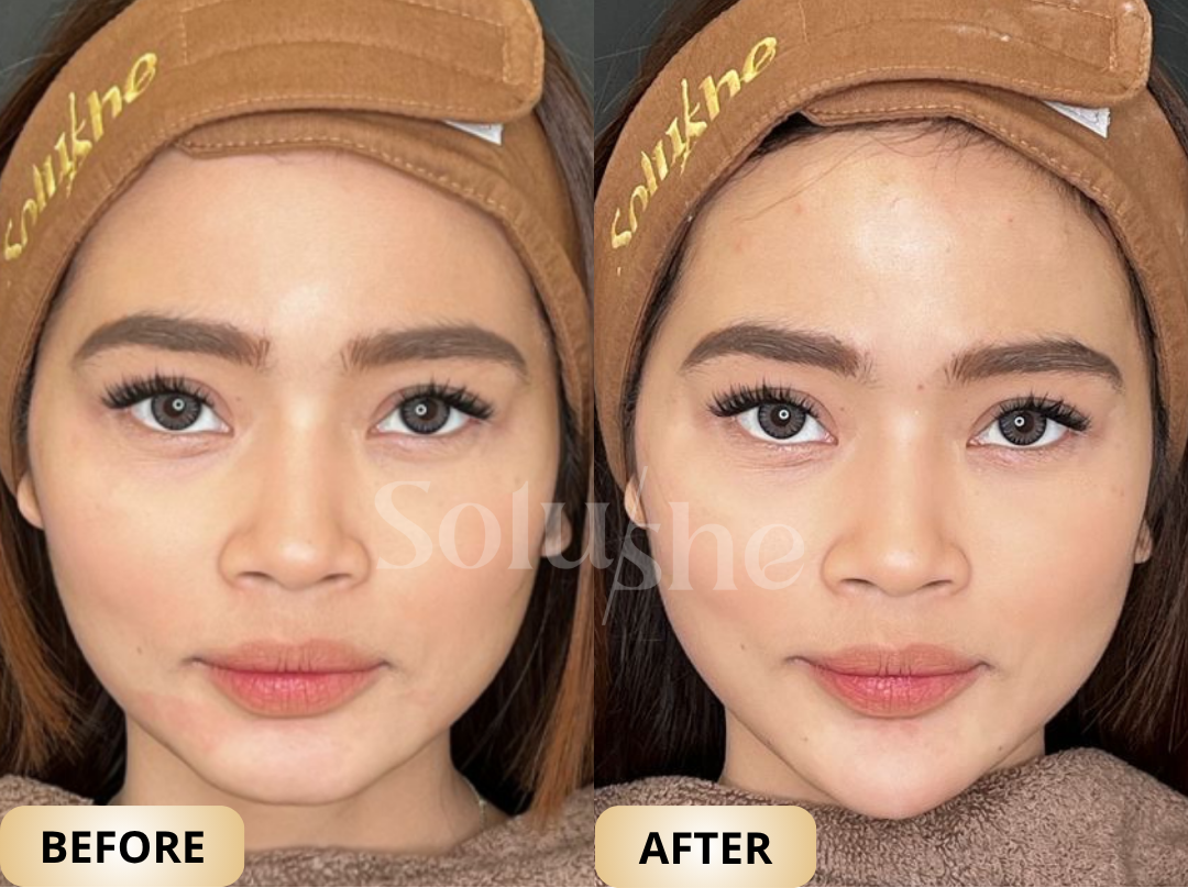 Hasil nyata before after Filler Dagu Solushe