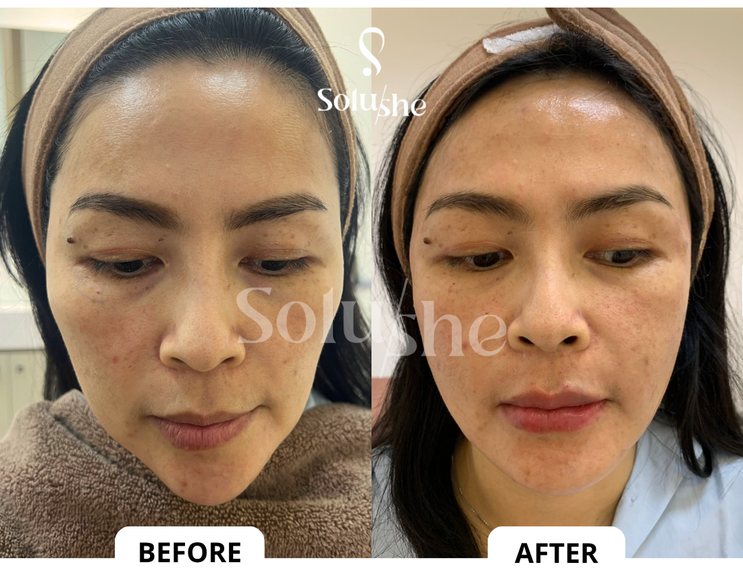 Hasil nyata before after Facetem Solushe