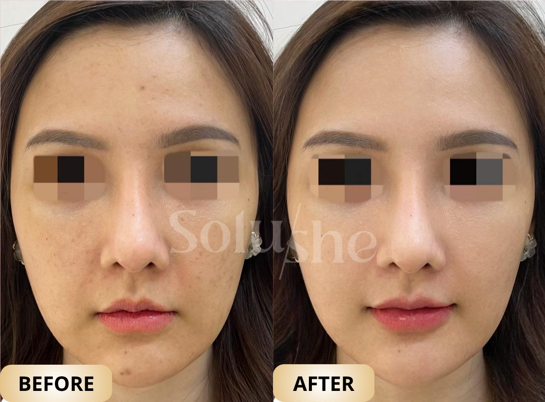 Hasil nyata before after Zuperglow Solushe