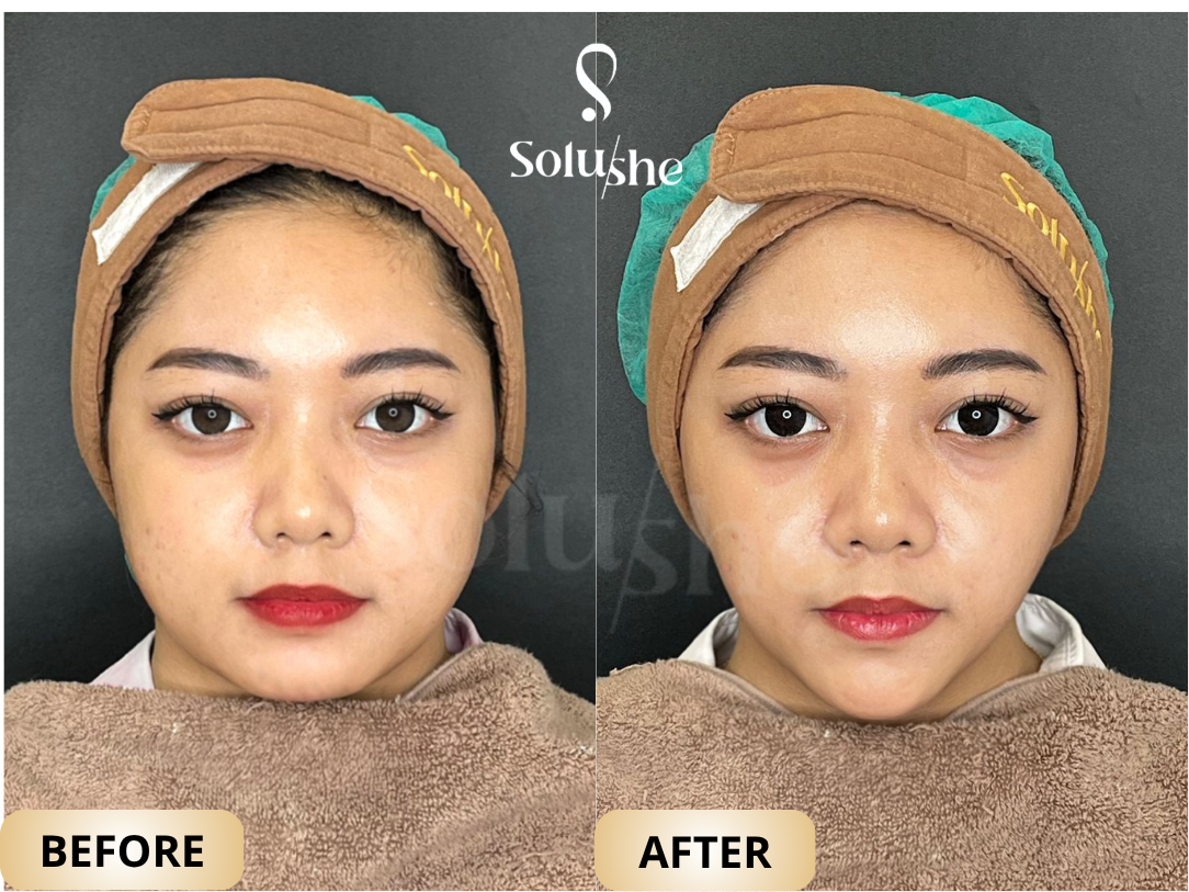 Hasil nyata before after Tirus instant 3 Solushe