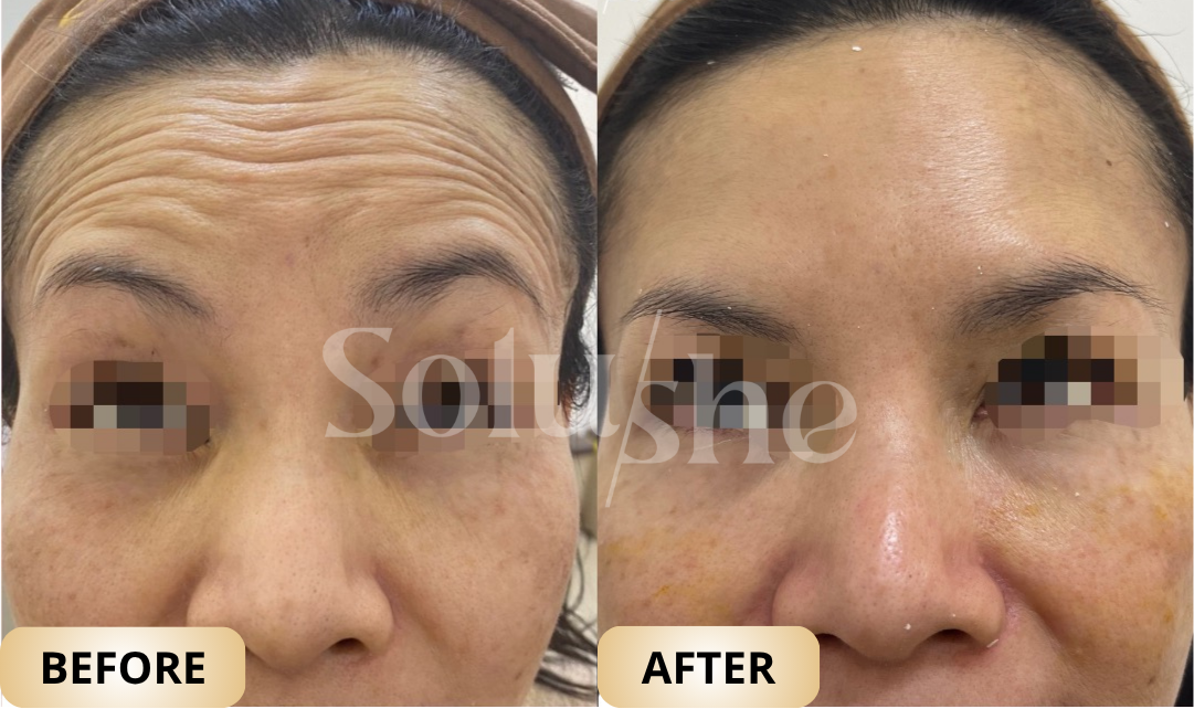Hasil nyata before after Botox Upperface Solushe