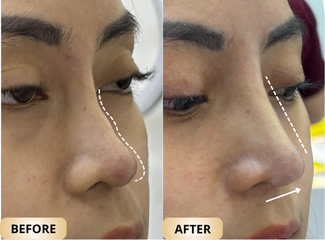 Hasil nyata before after Barbie Nose Solushe