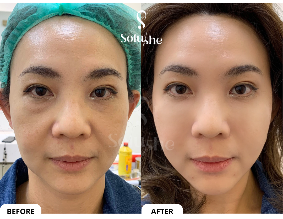 Hasil nyata before after Gouri Solushe