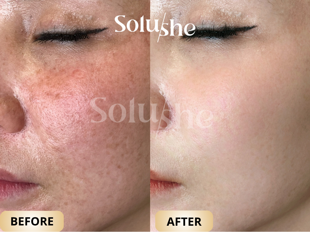 Hasil nyata before after Dermapen4 Solushe
