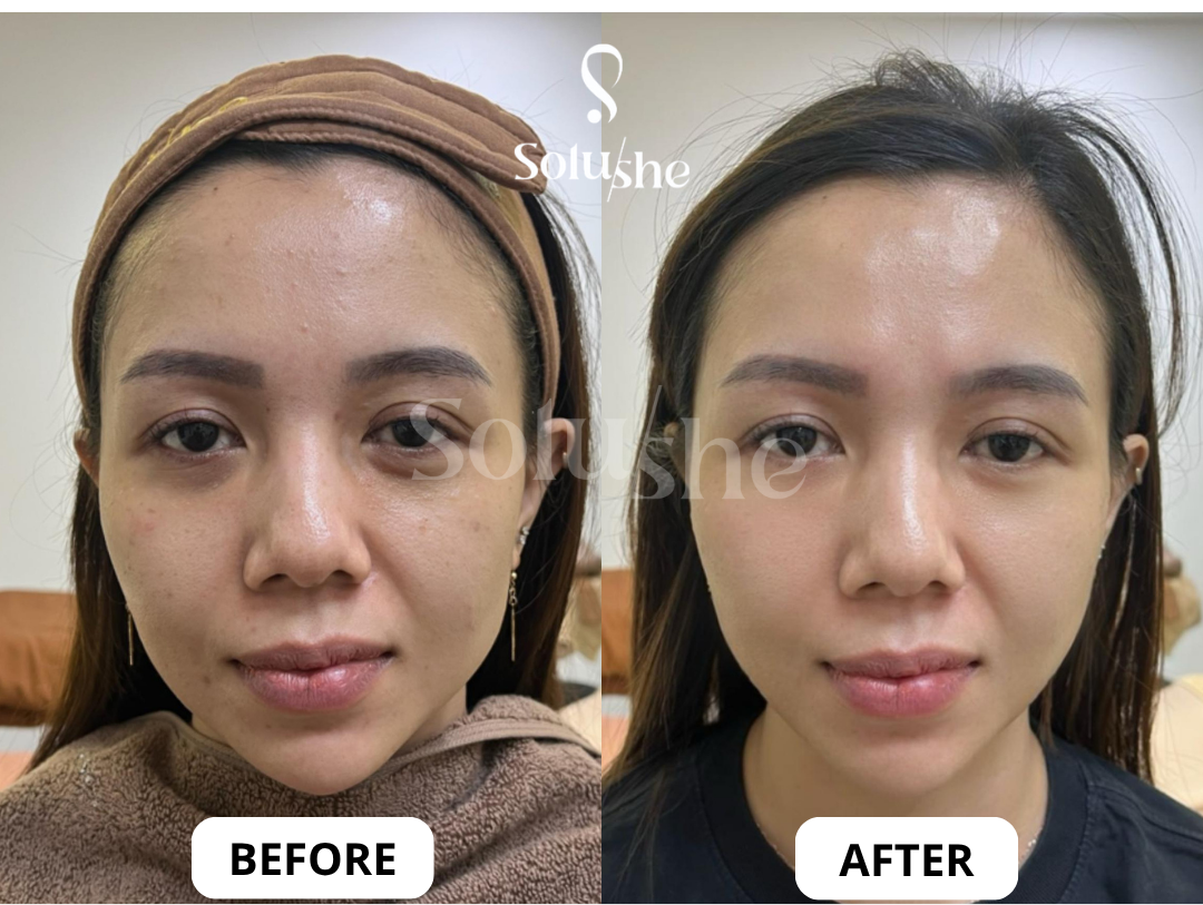 Hasil nyata before after Glowing Booster Solushe