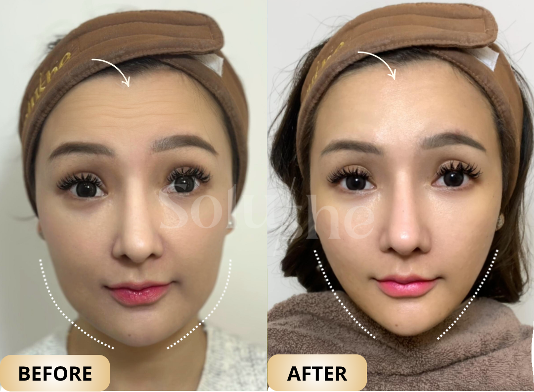Hasil nyata before after Botox Fullface Solushe