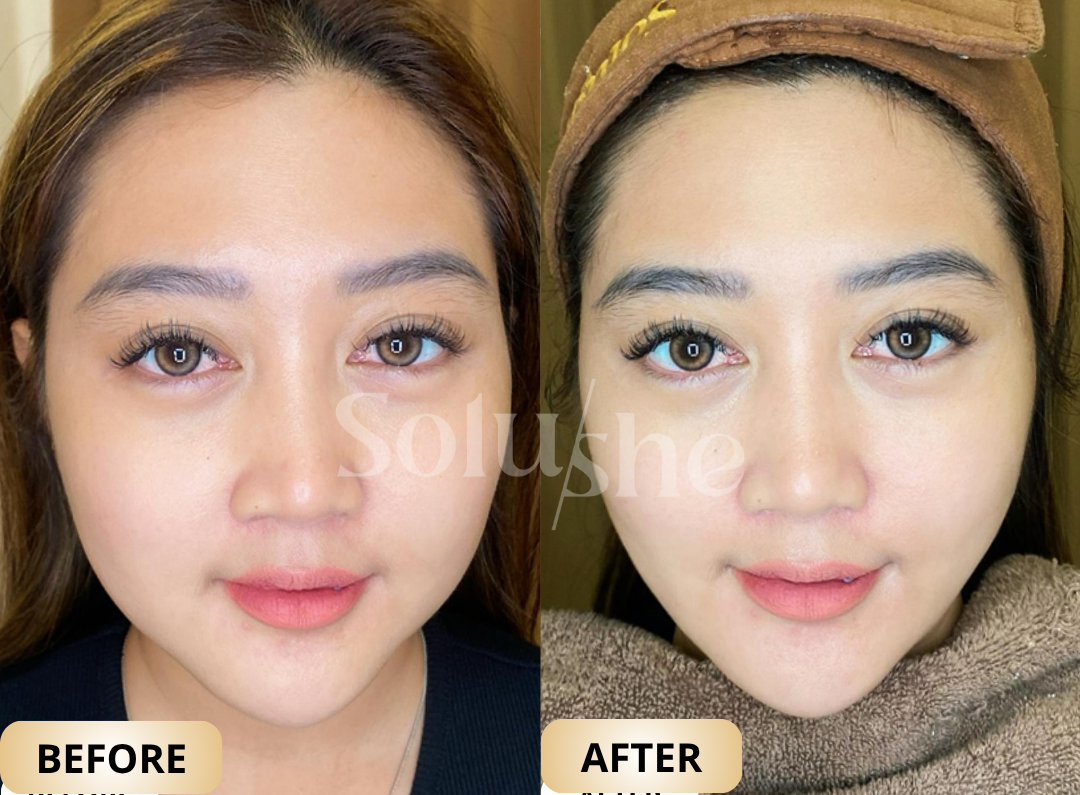 Hasil nyata before after MMFU Solushe