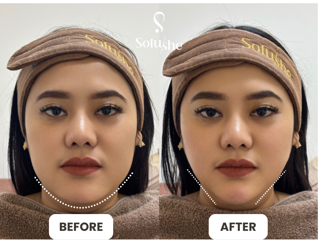 Hasil nyata before after Tirus Instant 2 Solushe