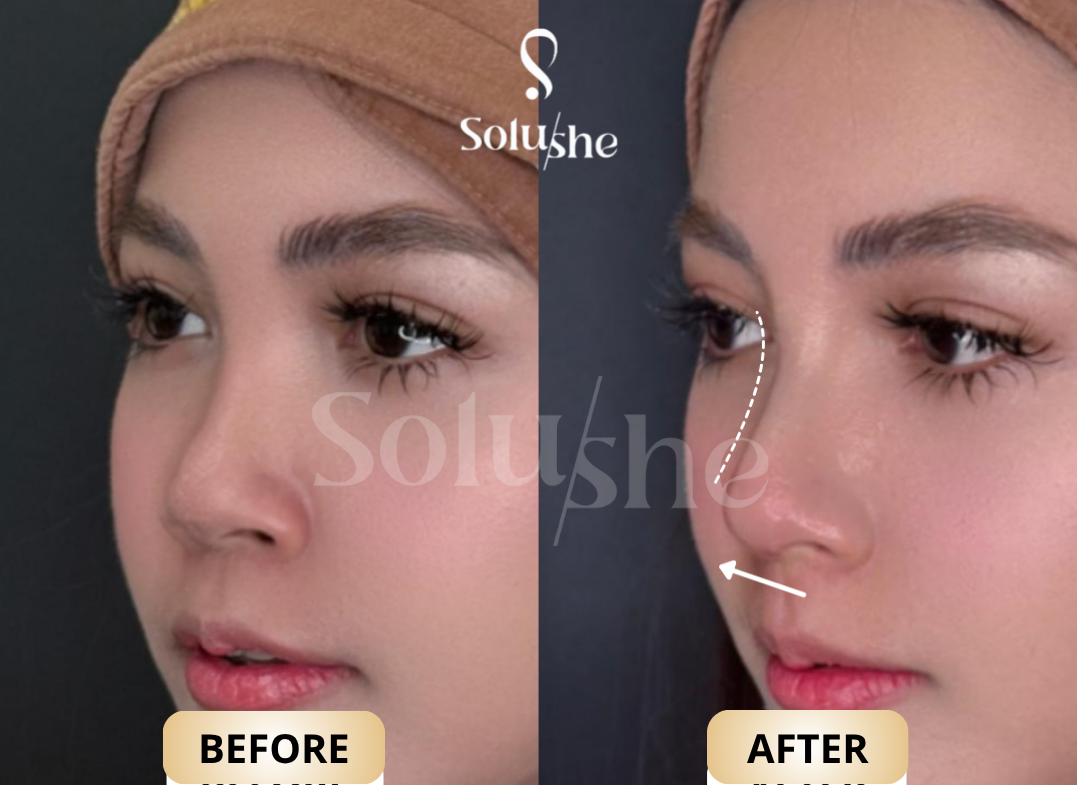 Hasil nyata before after Royal Implants Solushe