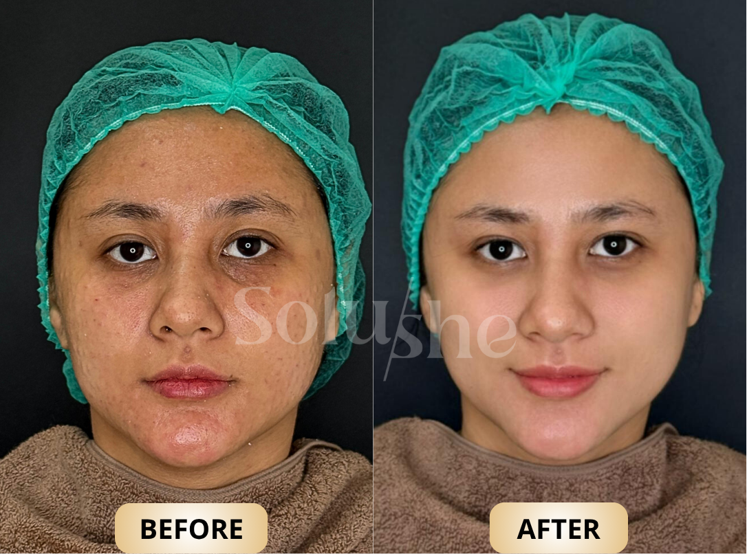 Hasil nyata before after Maxiglow Solushe